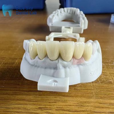 خرید تاج زرکونیا با لایه های بسیار شفاف با تاج کاشت online manufacture