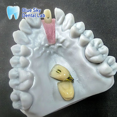 خرید زیربنای زرکونیا دقیق با تاج تک ایمپلنت online manufacture