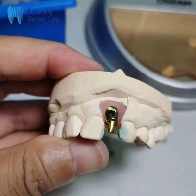 خرید کاستهای ایمپلنت معمولی کاستهای ایمپلنت تک تناسلی دندانهای آفسکت آرک online manufacture