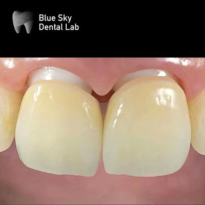 خرید ایمپلنت زرکونیا لایه دار تاج زرکونیا Abutment بیولوژیکی سازگار online manufacture