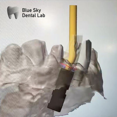 خرید Ti Base Screw Retained Abutment Implant Angled Screw Channel Abutment (پنجره ی پایه ای پیچ خورده شده و به صورت زاویه ای نصب شده) online manufacture