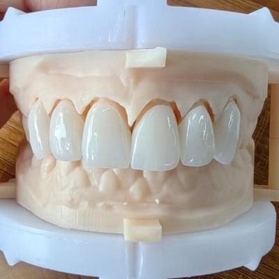 خرید زیبایی طبیعی پل تاج زرکونیا لایه دار برای لبخند زیبا و بازسازی خوب online manufacture