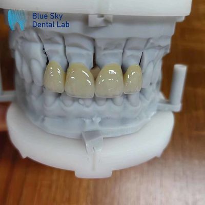 زرکونیای ماندگار لایه بندی شده با پورسلین زرکونیای چند لایه تاج