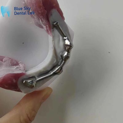 میله تیتانیوم دندانی قابل تنظیم با دندان های زیر دندانی برای پروتز دندان