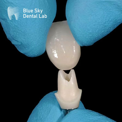 اسکن شفاهی Abutment Zirconia سفارشی Abutments Zirconia با قدرت بالا
