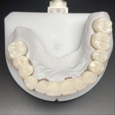 پل زيرکونياي لايه دار براي تعمير ثابت لبخند هاي زيبا حرفه اي پايدار